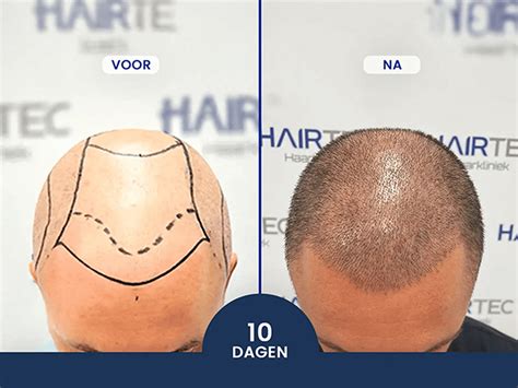 Aftercare Tips Voor Haartransplantatie
