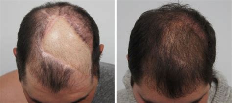 Haartransplantatie Bij Littekens: Is Het Mogelijk?