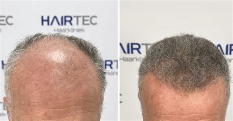 Haartransplantatie Resultaten: Hoe Lang Duurt Het?